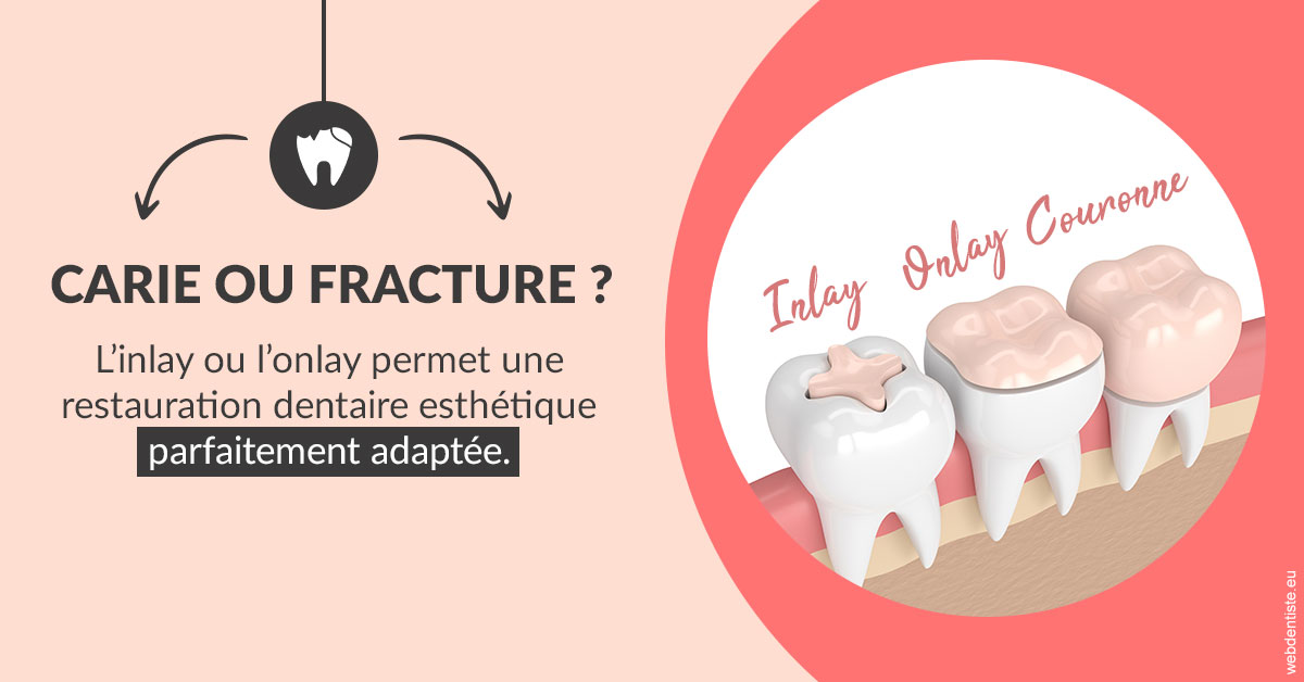 https://dr-laurent-sers.chirurgiens-dentistes.fr/T2 2023 - Carie ou fracture 2