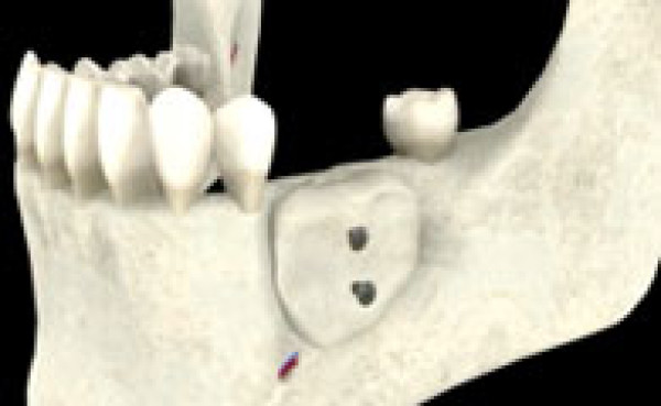 La greffe osseuse d'apposition ou greffe en onlay