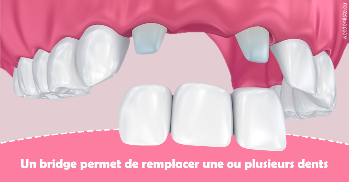 https://dr-laurent-sers.chirurgiens-dentistes.fr/Bridge remplacer dents 2