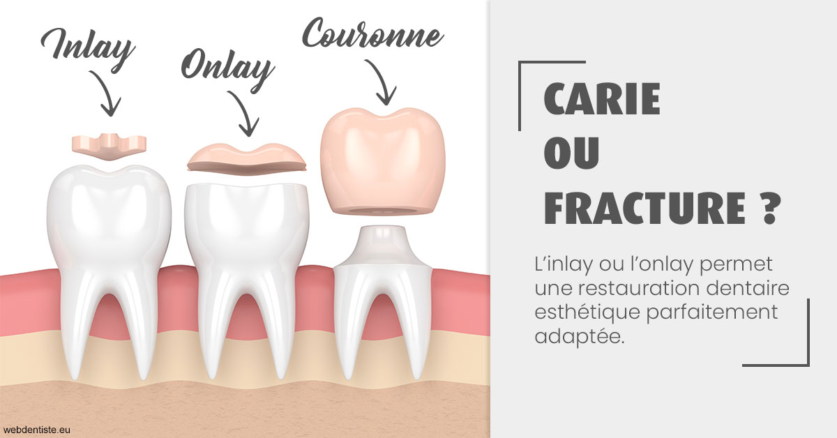 https://dr-laurent-sers.chirurgiens-dentistes.fr/T2 2023 - Carie ou fracture 1