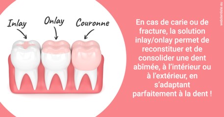 https://dr-laurent-sers.chirurgiens-dentistes.fr/L'INLAY ou l'ONLAY 2