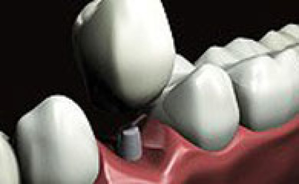 Les différents types de prothèses dentaires