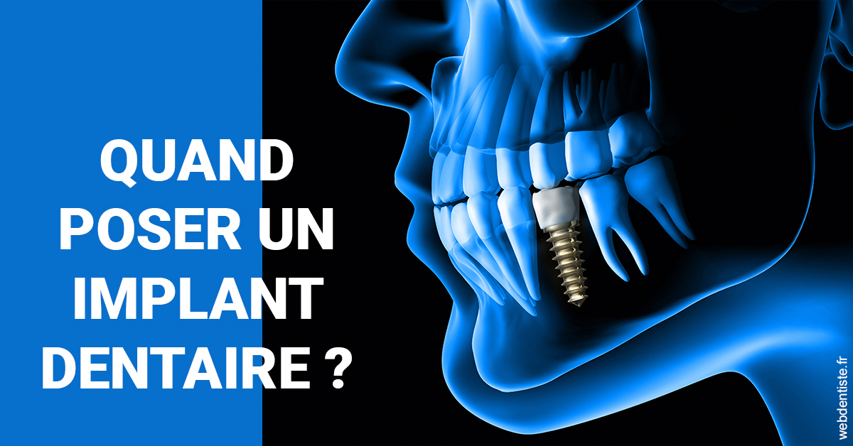 https://dr-laurent-sers.chirurgiens-dentistes.fr/Les implants 1