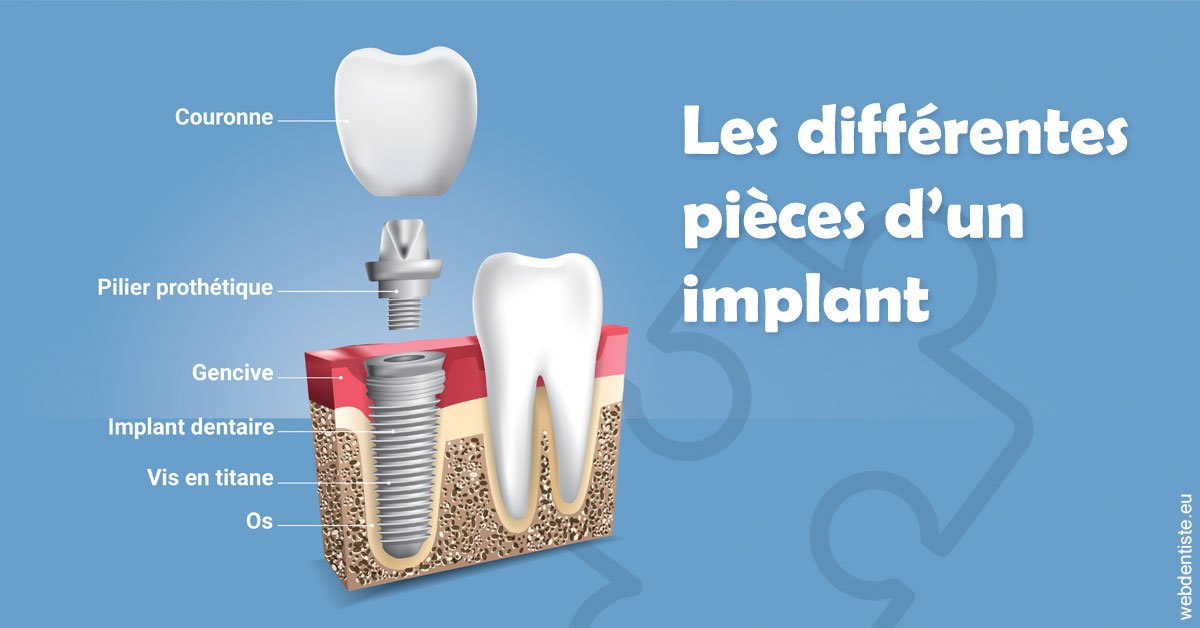 https://dr-laurent-sers.chirurgiens-dentistes.fr/Les différentes pièces d’un implant 1