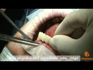 Immediate Smile Bridge par Dr Laurent Sers
