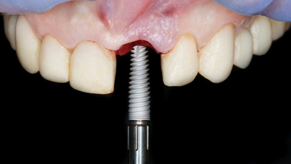 Douleur de la pose d'un implant
