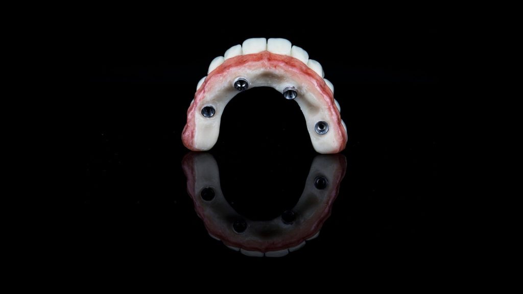 Dental Implant in Cannes - Dr Laurent SERS