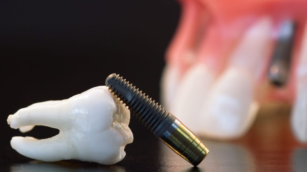 Dental Implant in Cannes - Dr Laurent SERS