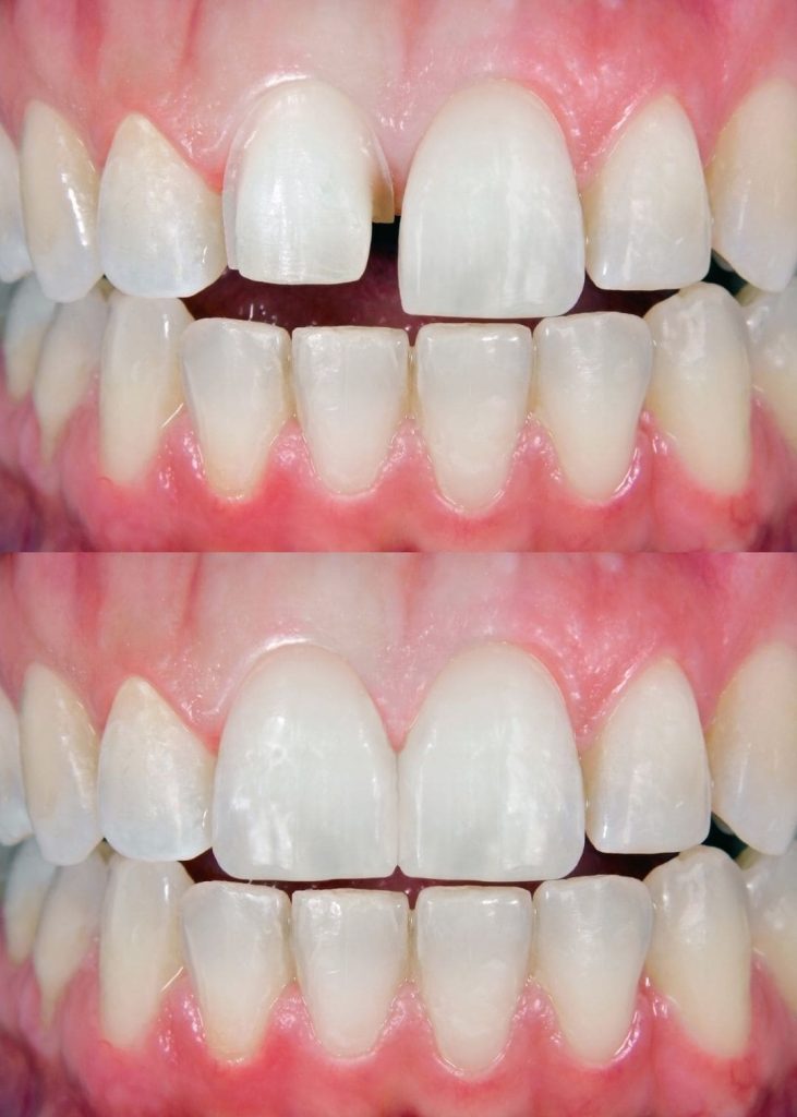 Chirurgie esthétique dentaire cannes