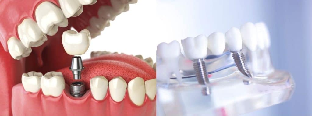 Choisir entre un implant ou un bridge dentaire