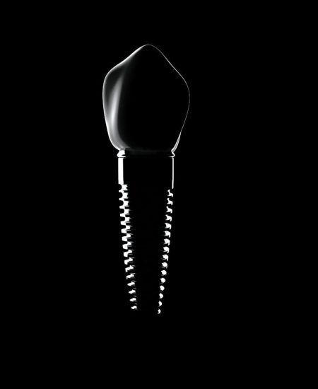 Dental Implant in Cannes - Dr Laurent SERS